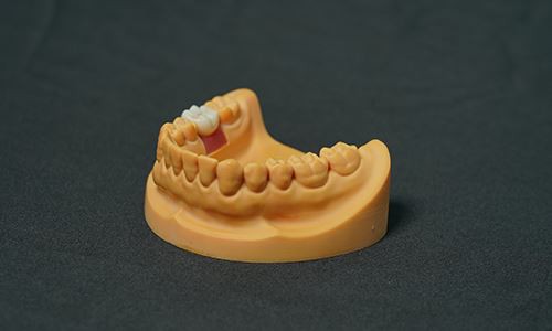 Emax All-porcelain Implant